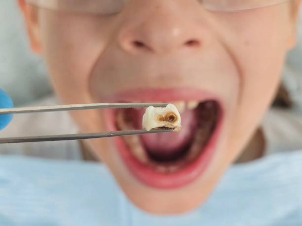 Best Emergency Treatment for Toothache in Whitesboro, TX